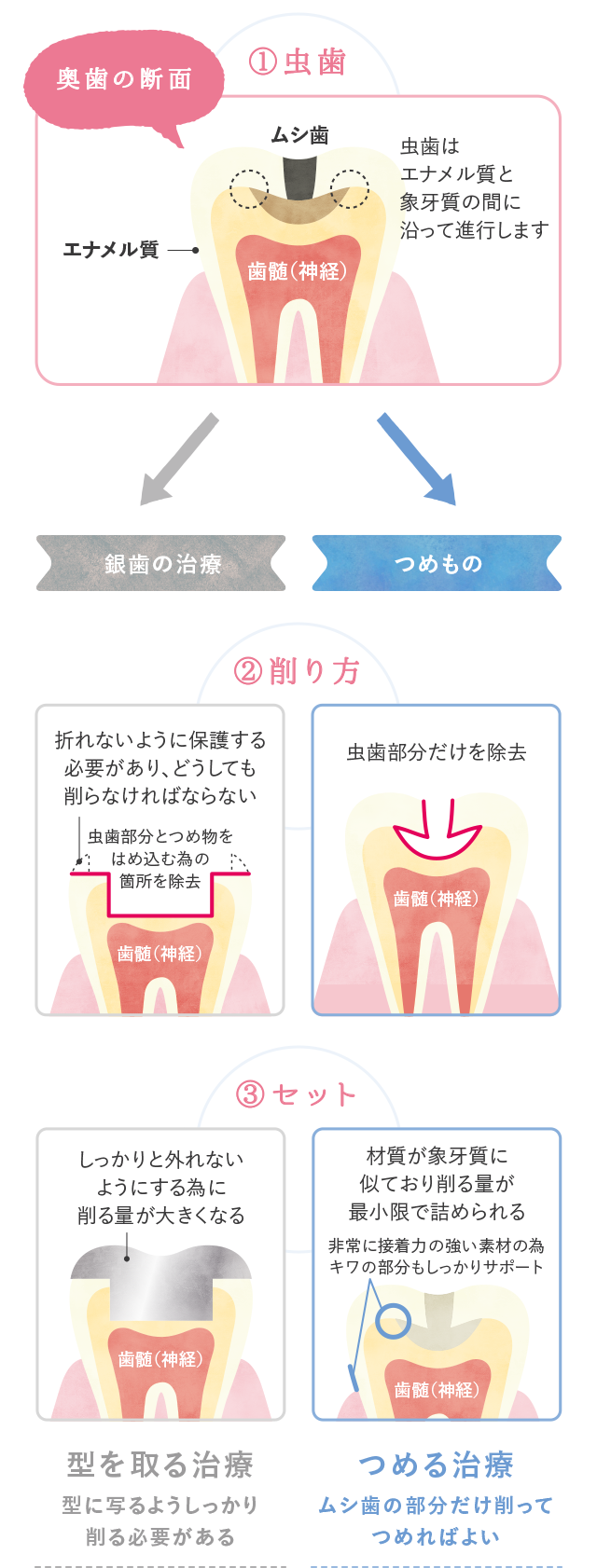 銀歯との違い